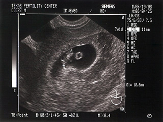 Mojo's Fetus 1